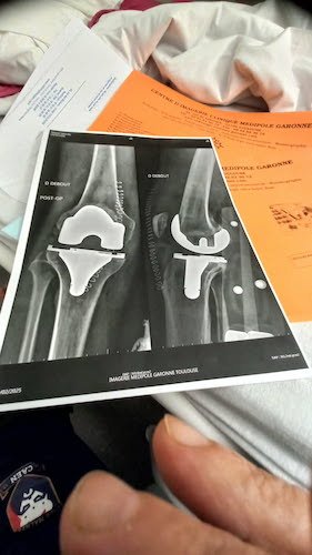 La photo du genou de Miguel APRÈS.jpg