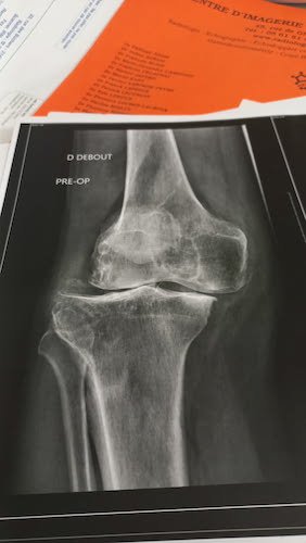 La photo du genou de Miguel AVANT.jpg